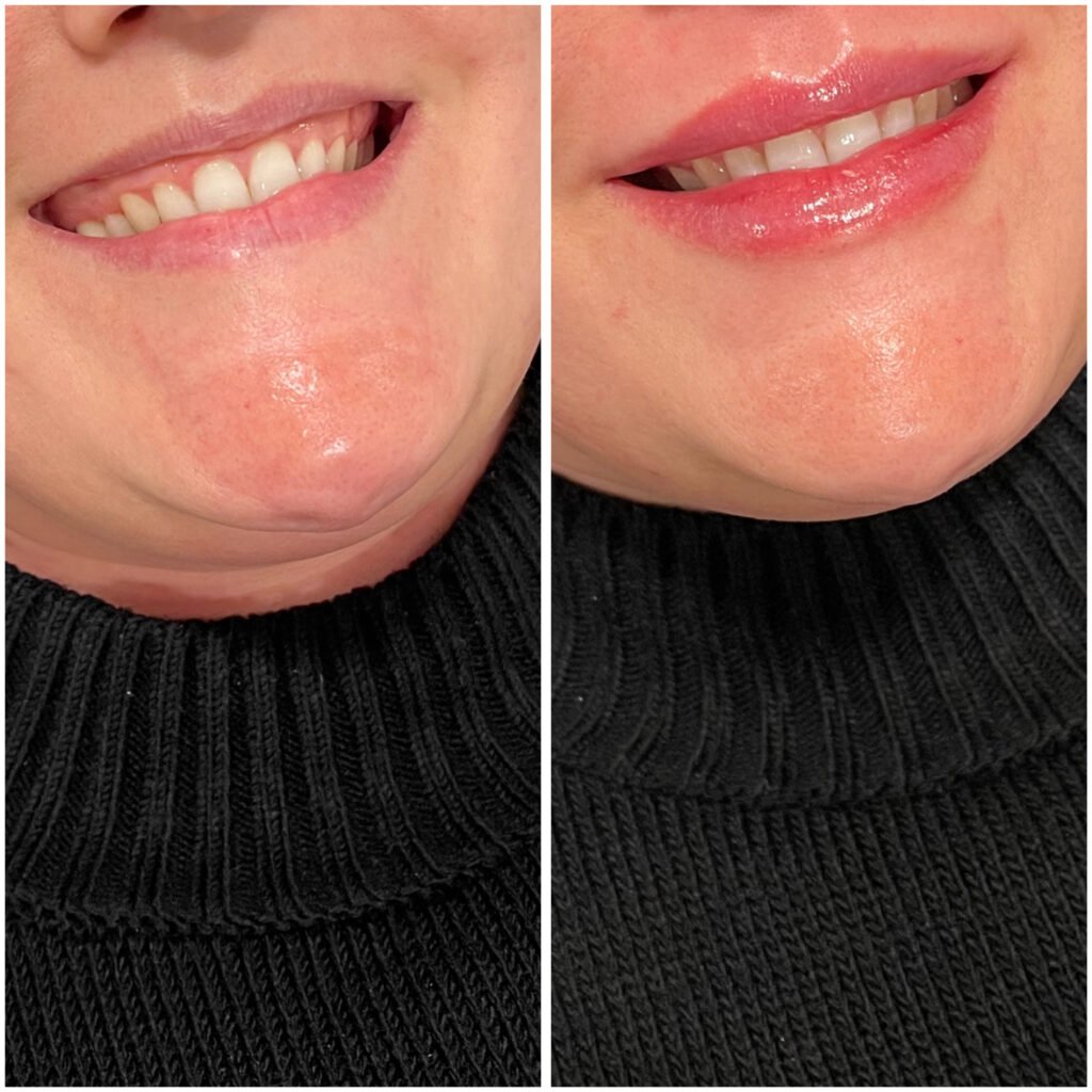 aumento labial + sonrisa gingival