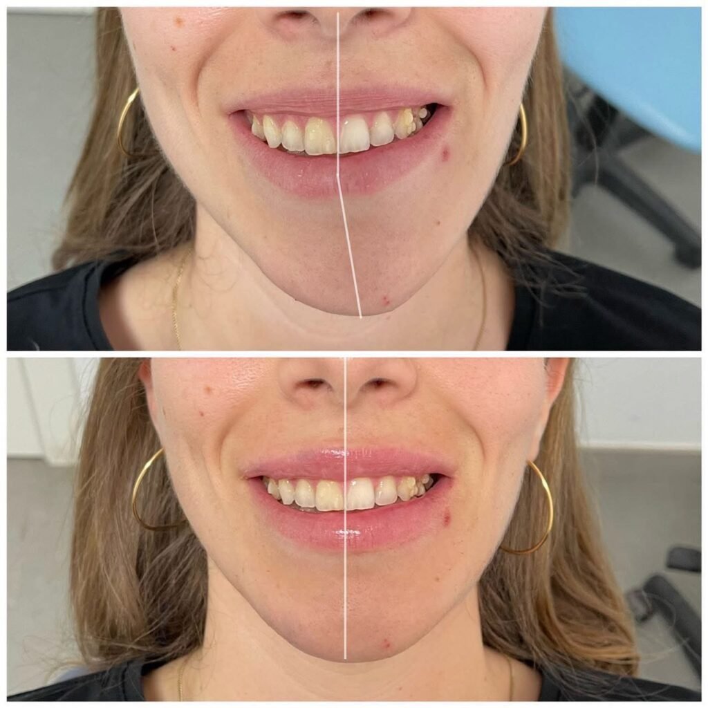 corrección asimetría de menton