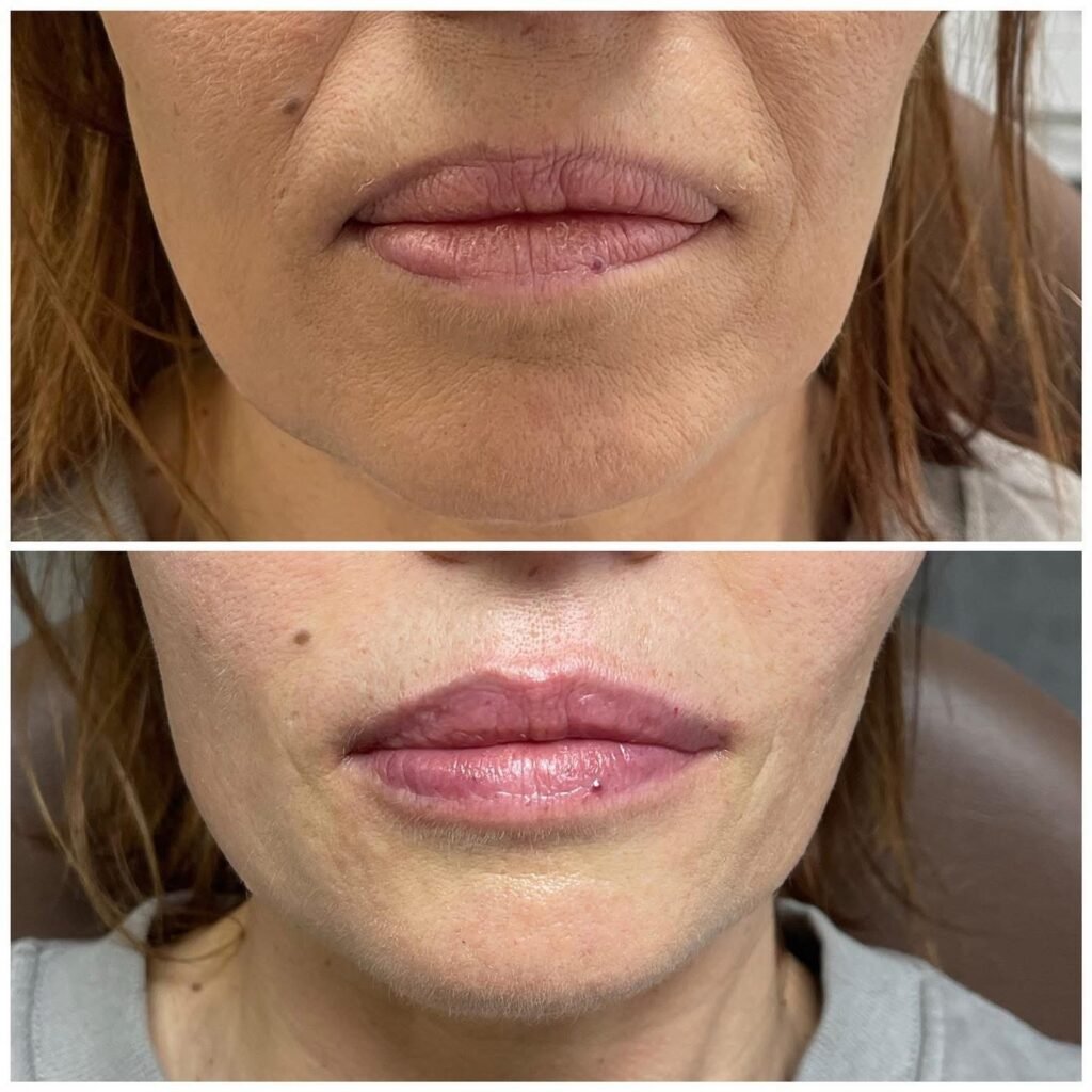 labios con silicona_polimero previo